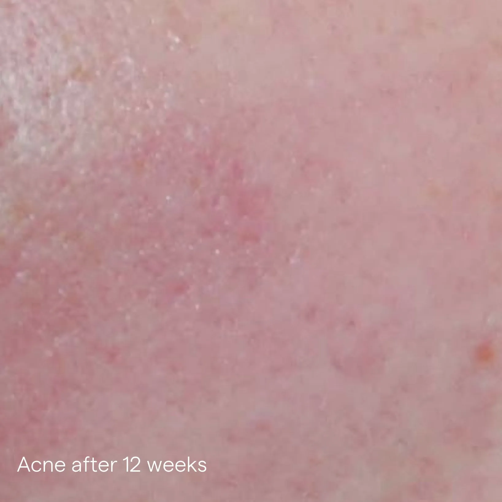 iS Clinical Active Serum